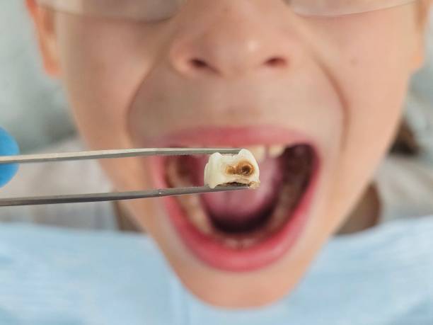 Best Emergency Tooth Extraction in Bainbridge, GA